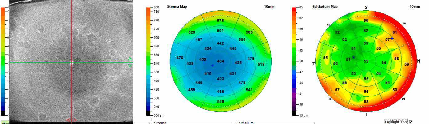OCT en face du film lacrymal montrant l'instabilit&eacute; de la couche lipidique et la correspondance en &eacute;pimapping