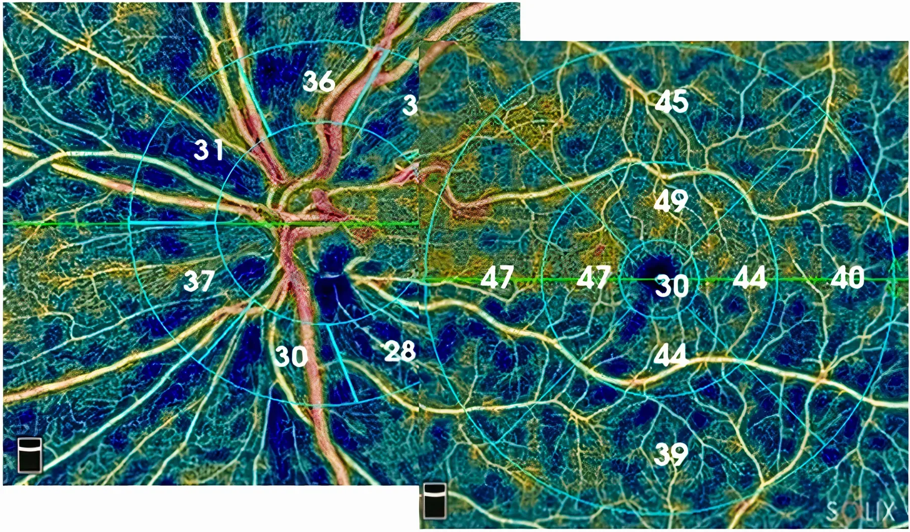 Image OCTA montrant la densité vasculaire du nerf optique et de la macula chez un patient glaucomateux