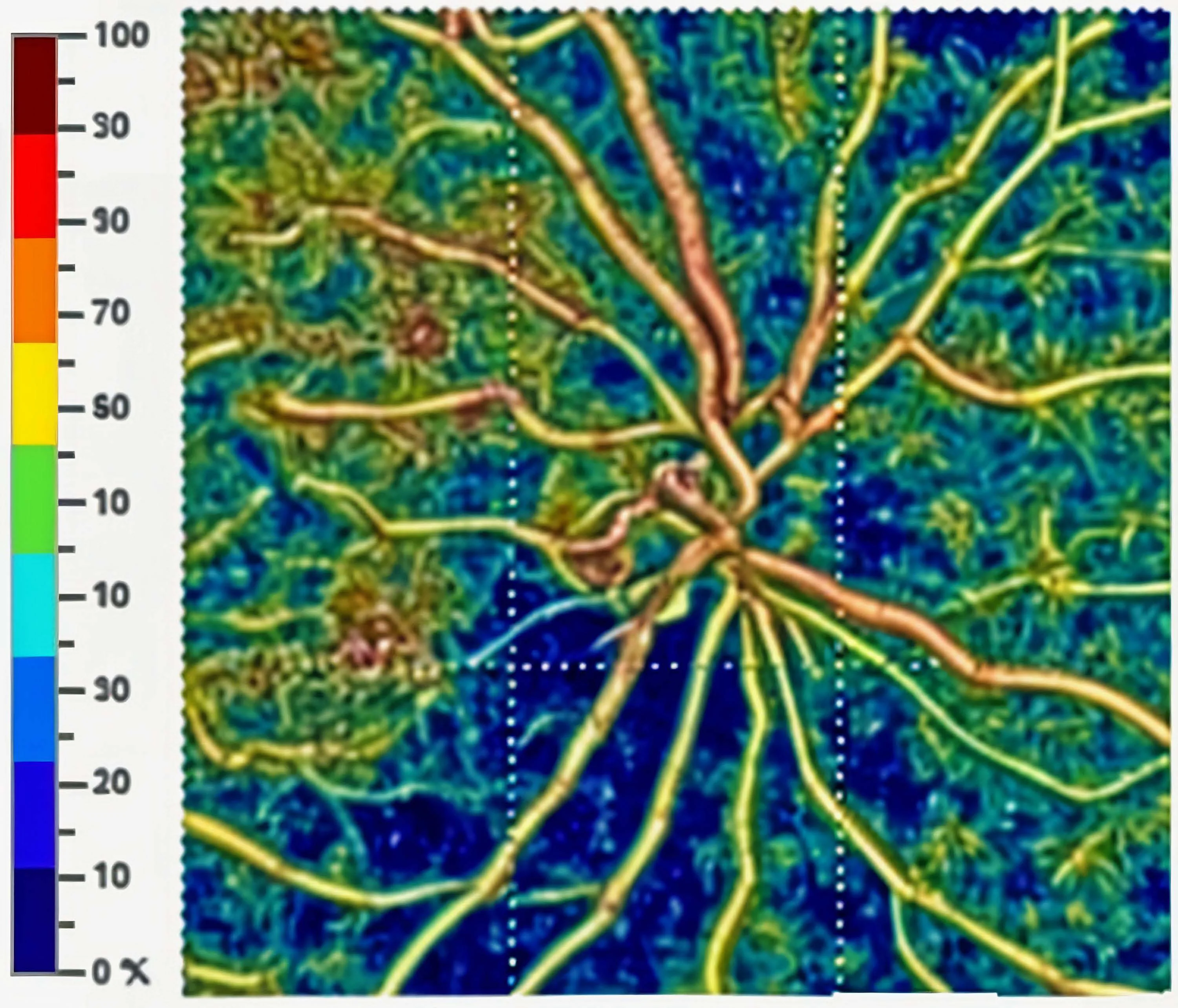 Cartographie de la densité vasculaire du nerf optique en OCTA
