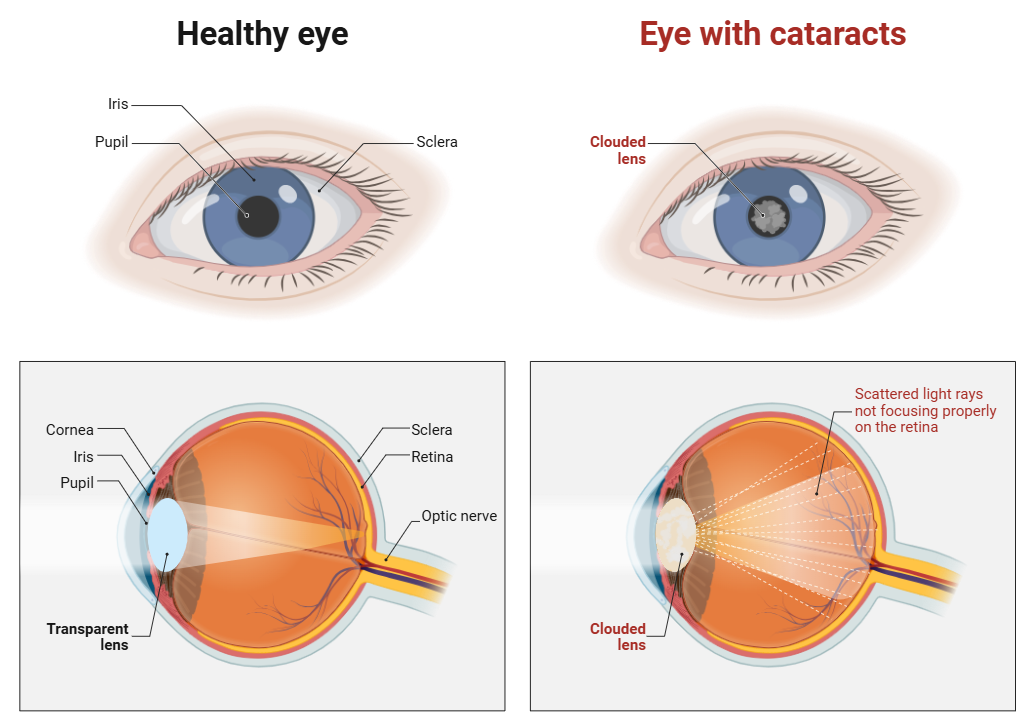 Comparaison d'un œil sain et d'un œil avec cataracte : le cristallin opacifié disperse la lumière