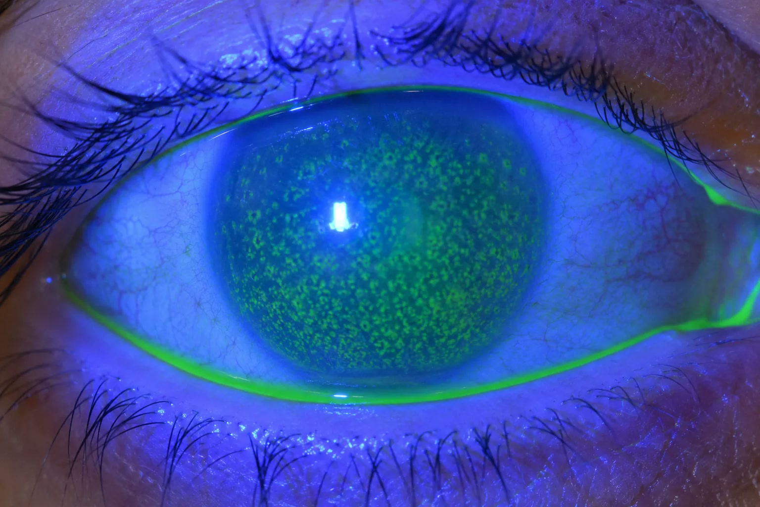 Coloration &agrave; la fluoresc&eacute;ine montrant des ponctuations de la corn&eacute;e dans une s&eacute;cheresse oculaire