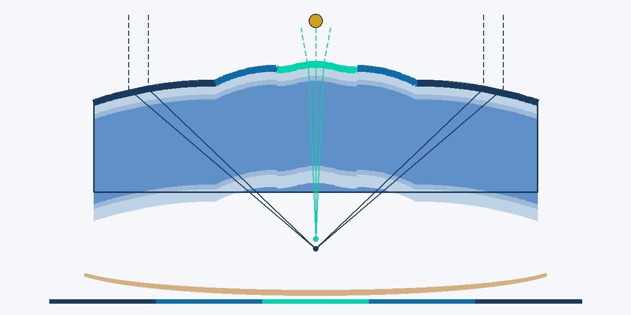 Sch&eacute;ma en coupe de la corn&eacute;e apr&egrave;s presby-LASIK&nbsp;: la zone centrale est l&eacute;g&egrave;rement bomb&eacute;e pour la vision de pr&egrave;s (foyer proche), la zone interm&eacute;diaire assure la transition, la zone p&eacute;riph&eacute;rique conserve le profil de distance&nbsp;; les trois foyers convergent sur la r&eacute;tine selon la distance consid&eacute;r&eacute;e.