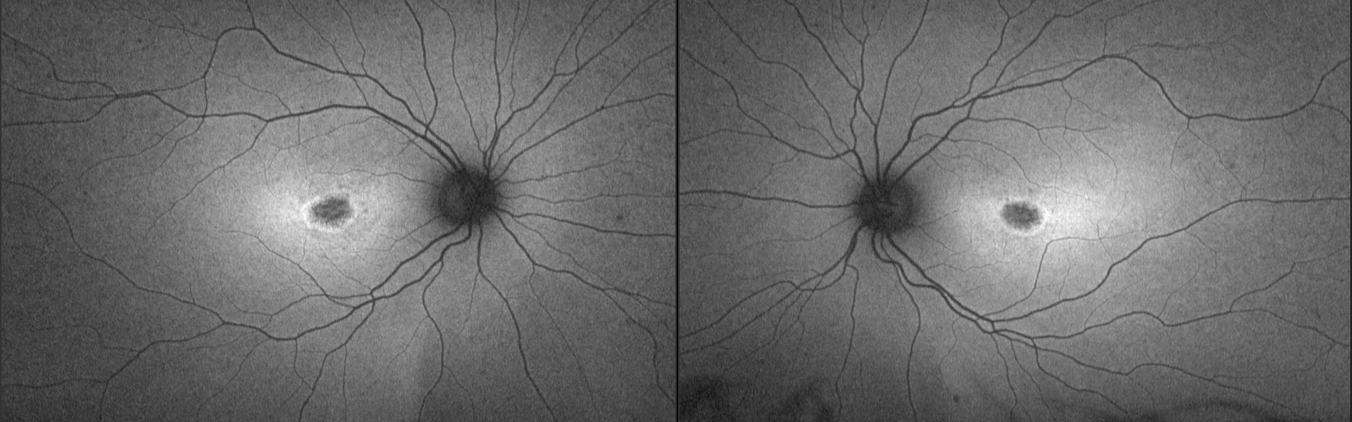 Autofluorescence du fond d'œil des deux yeux montrant des lésions maculaires centrales de Stargardt