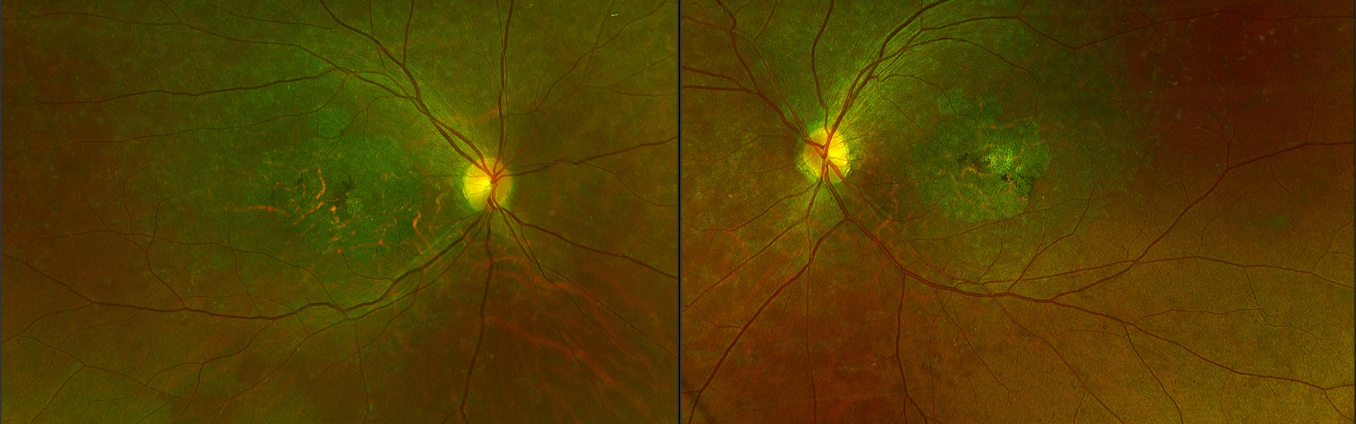 Photographies rétiniennes ultra-grand champ des deux yeux illustrant une forme tardive de maladie de Stargardt