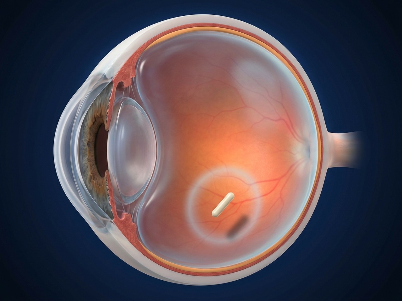 Coupe de l'&oelig;il en vue 3D&nbsp;: un petit implant cylindrique blanc de dexam&eacute;thasone repose dans la partie basse de la cavit&eacute; vitr&eacute;enne, en dehors de l'axe visuel, entour&eacute; d'un halo diffus repr&eacute;sentant la lib&eacute;ration progressive du m&eacute;dicament.