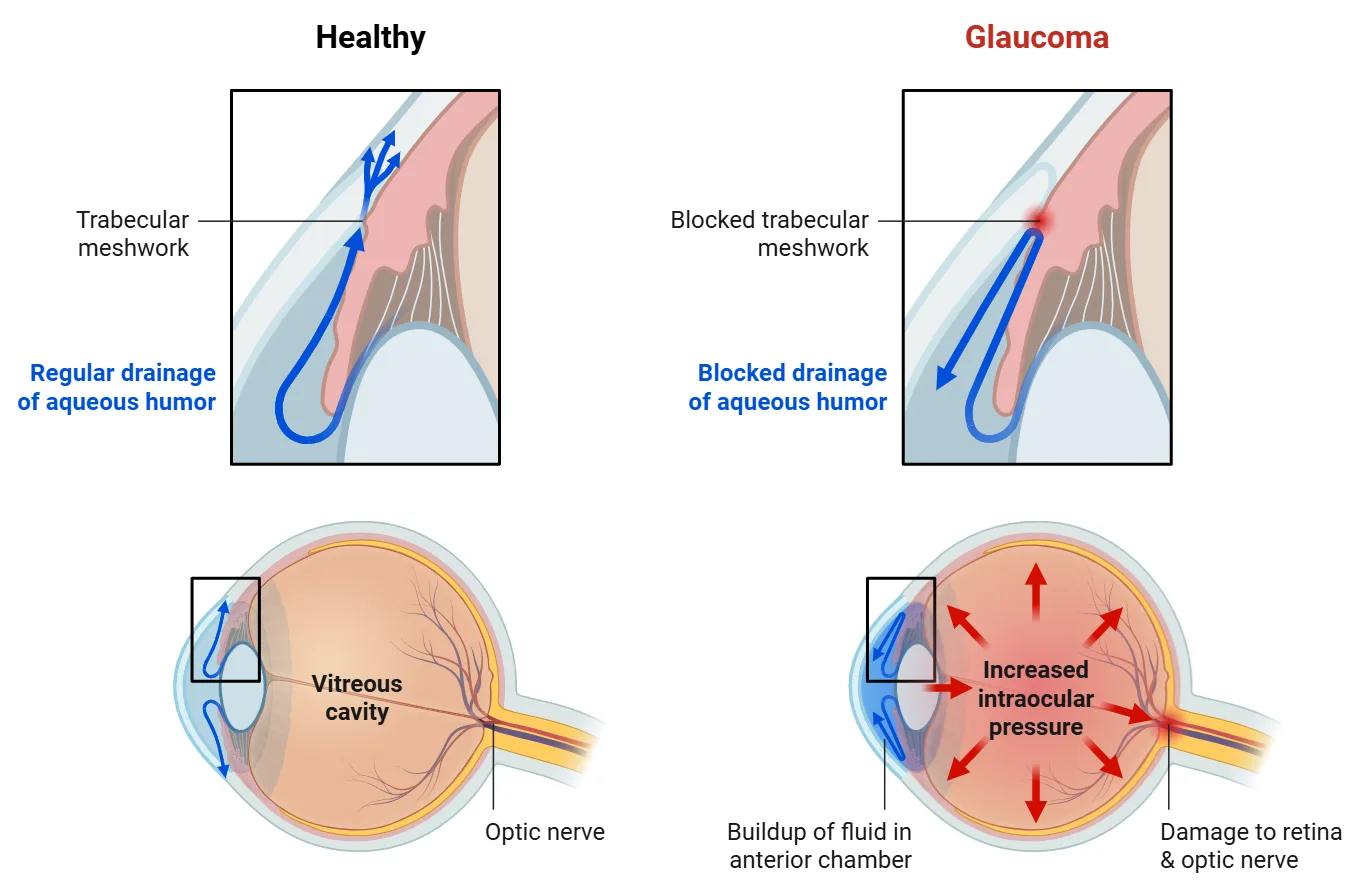 Comparaison &oelig;il sain et glaucome : &agrave; gauche, drainage normal de l'humeur aqueuse via le trabeculum ; &agrave; droite, trabeculum bloqu&eacute;, pression intraoculaire augment&eacute;e et l&eacute;sion du nerf optique.