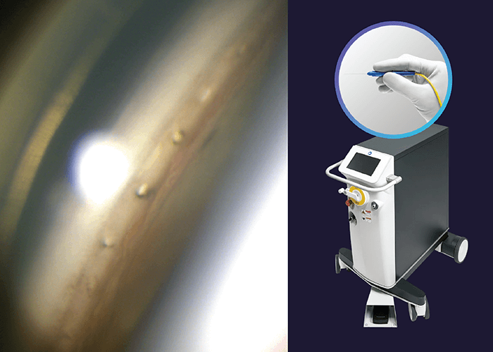 Syst&egrave;me laser ELIOS &mdash; sonde &agrave; fibre optique cr&eacute;ant des microouvertures dans le trab&eacute;culum