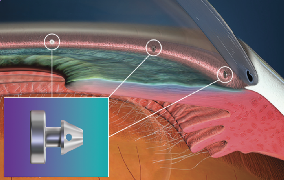 Illustration de l'implantation d'un iStent inject dans le trabéculum — micro-stent créant un pont entre la chambre antérieure et le canal de Schlemm