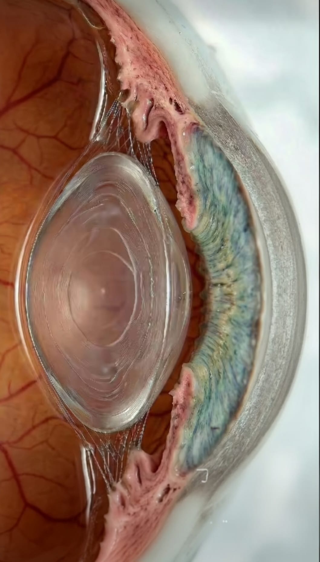 Cristallin opacifié par la cataracte — coupe sagittale de l'œil montrant l'opacification du cristallin