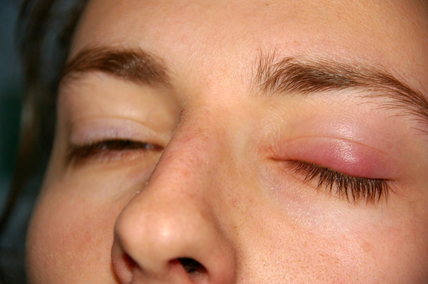 Chalazion de la paupière supérieure