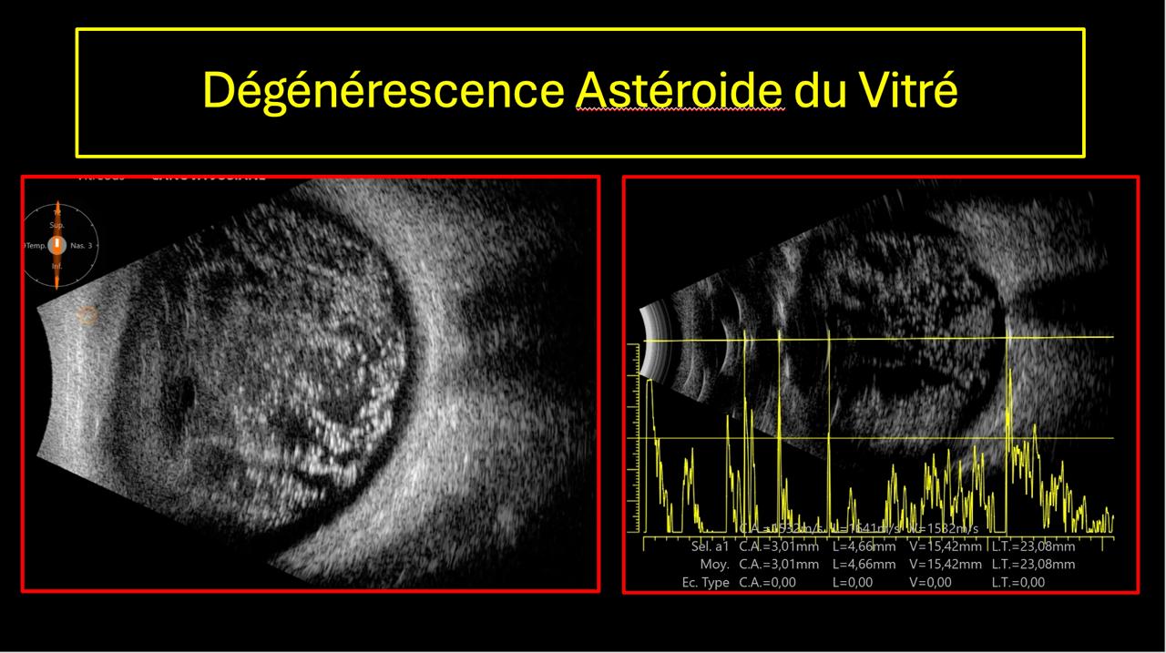 Hyalose astéroïde — échos punctiformes brillants dans le vitré avec tracé A