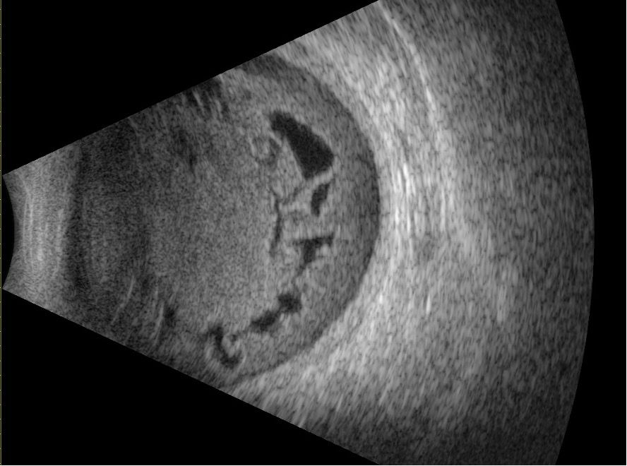 Hémorragie intravitréenne massive avec membranes organisées en échographie mode B
