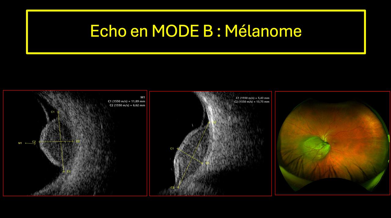 Mélanome choroïdien en mode B avec mesures d'épaisseur et corrélation au fond d'œil Optos