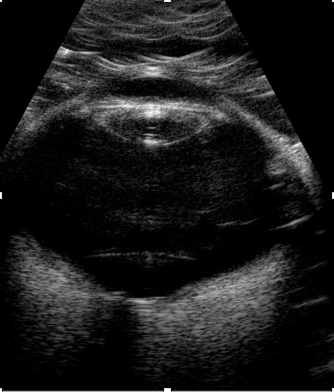 Échographie mode B — coupe axiale du globe oculaire avec cristallin et vitré