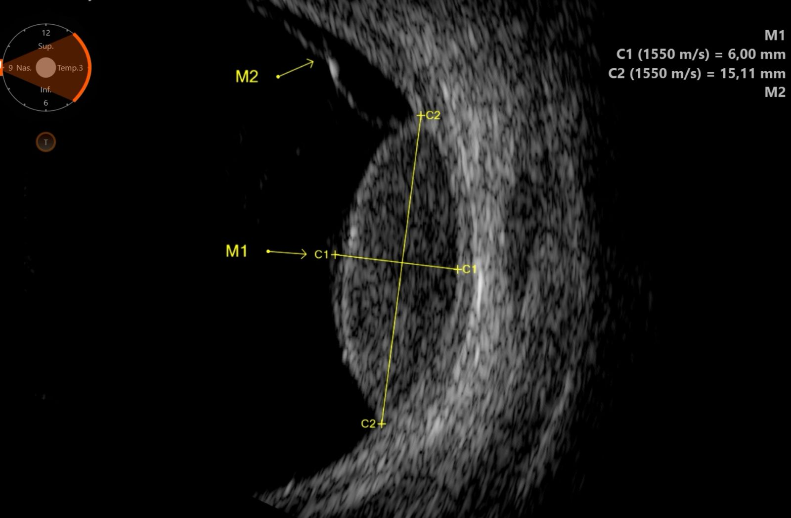 Mélanome intraoculaire — mesures échographiques du diamètre basal et de la hauteur tumorale