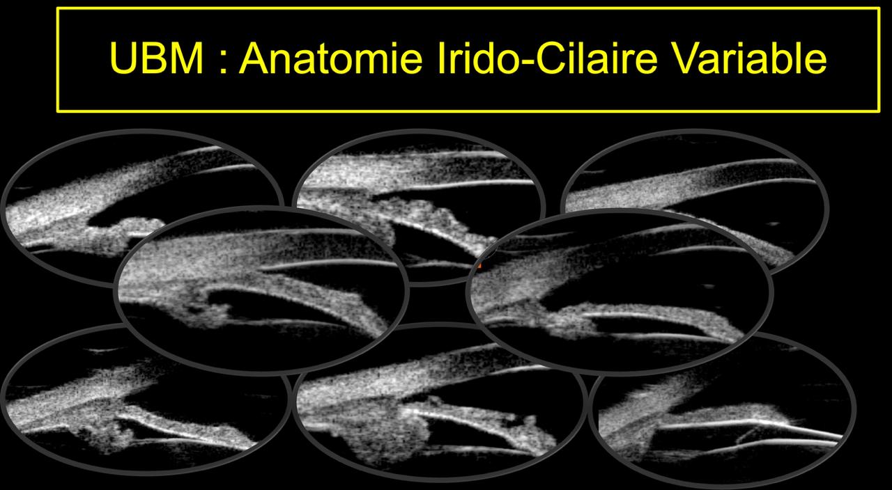 UBM 50 MHz — 6 variantes anatomiques de l'angle irido-ciliaire et du corps ciliaire