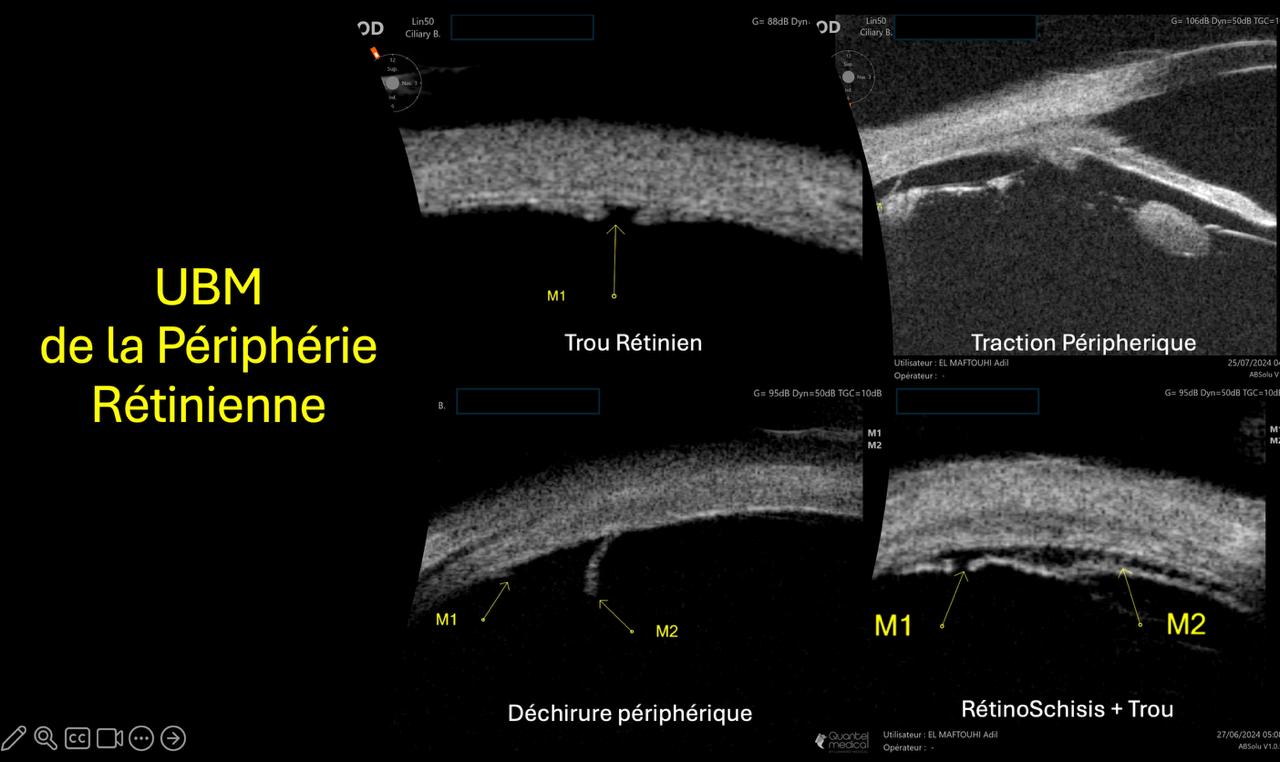 UBM de la périphérie rétinienne — trou rétinien, traction, déchirure et rétinoschisis