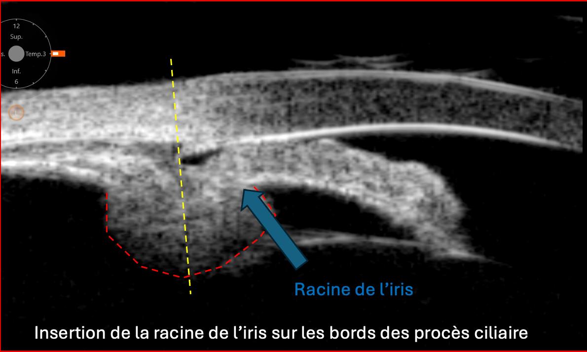UBM annotée — insertion de la racine de l'iris sur les procès ciliaires, angle et sulcus