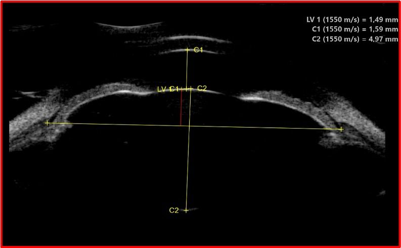 UBM segment antérieur — biométrie : cornée, chambre antérieure et cristallin