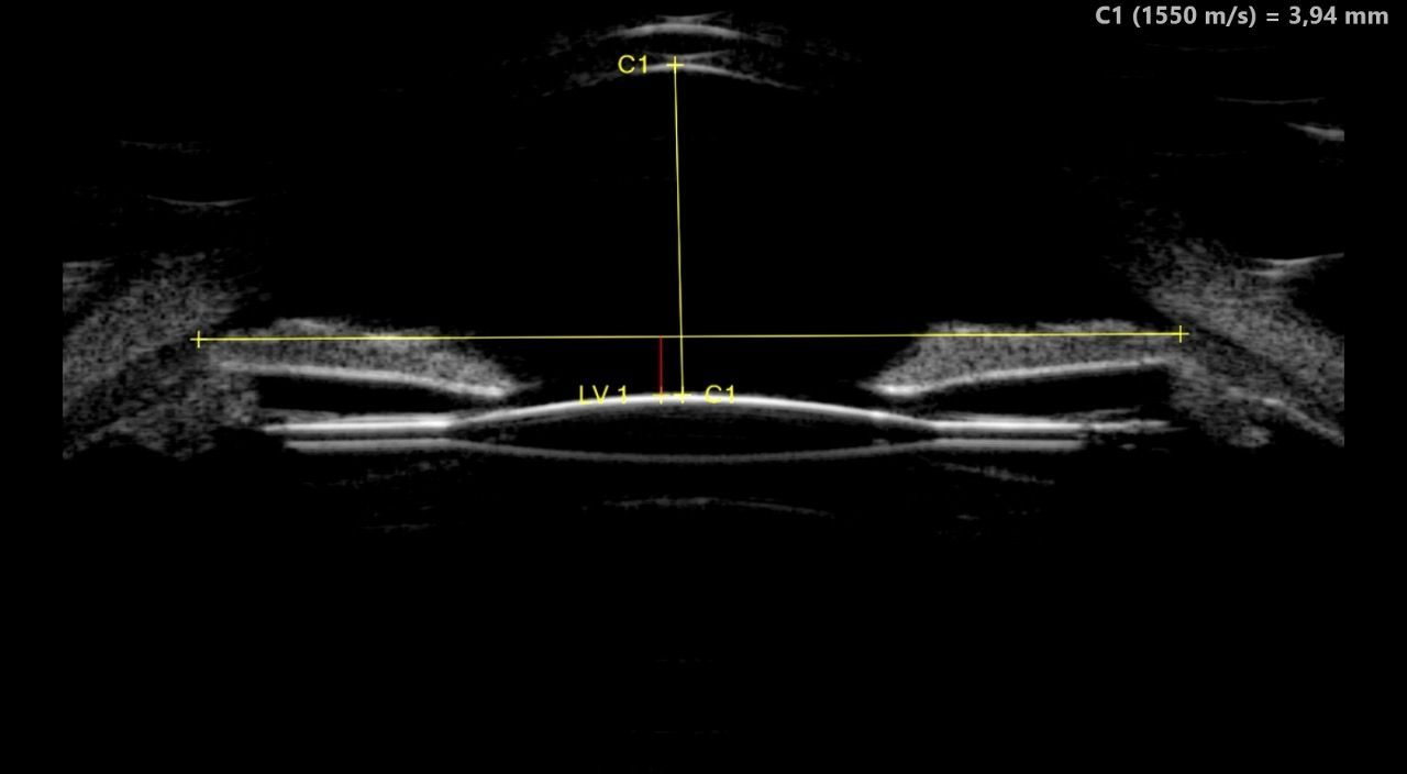 UBM segment antérieur — mesure de la profondeur de chambre antérieure et du diamètre cornéen