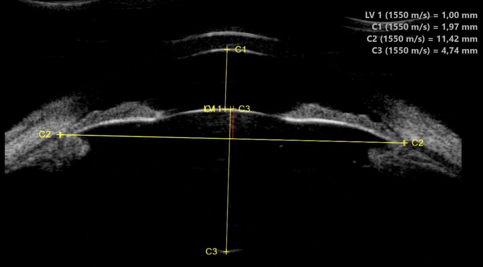UBM segment antérieur — mesures complètes : épaisseur cornéenne, cristallin, blanc-à-blanc et profondeur