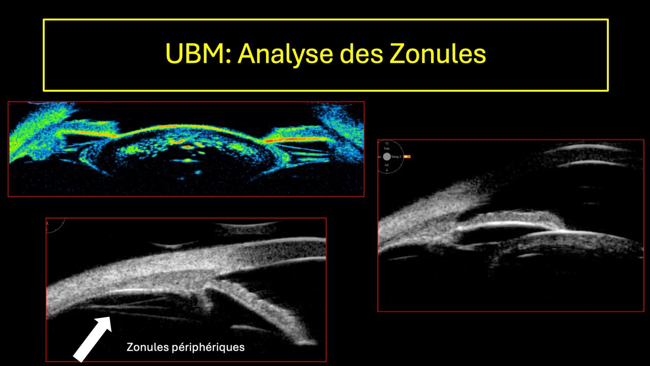 UBM — visualisation des zonules avec cartographie couleur et coupe en niveaux de gris