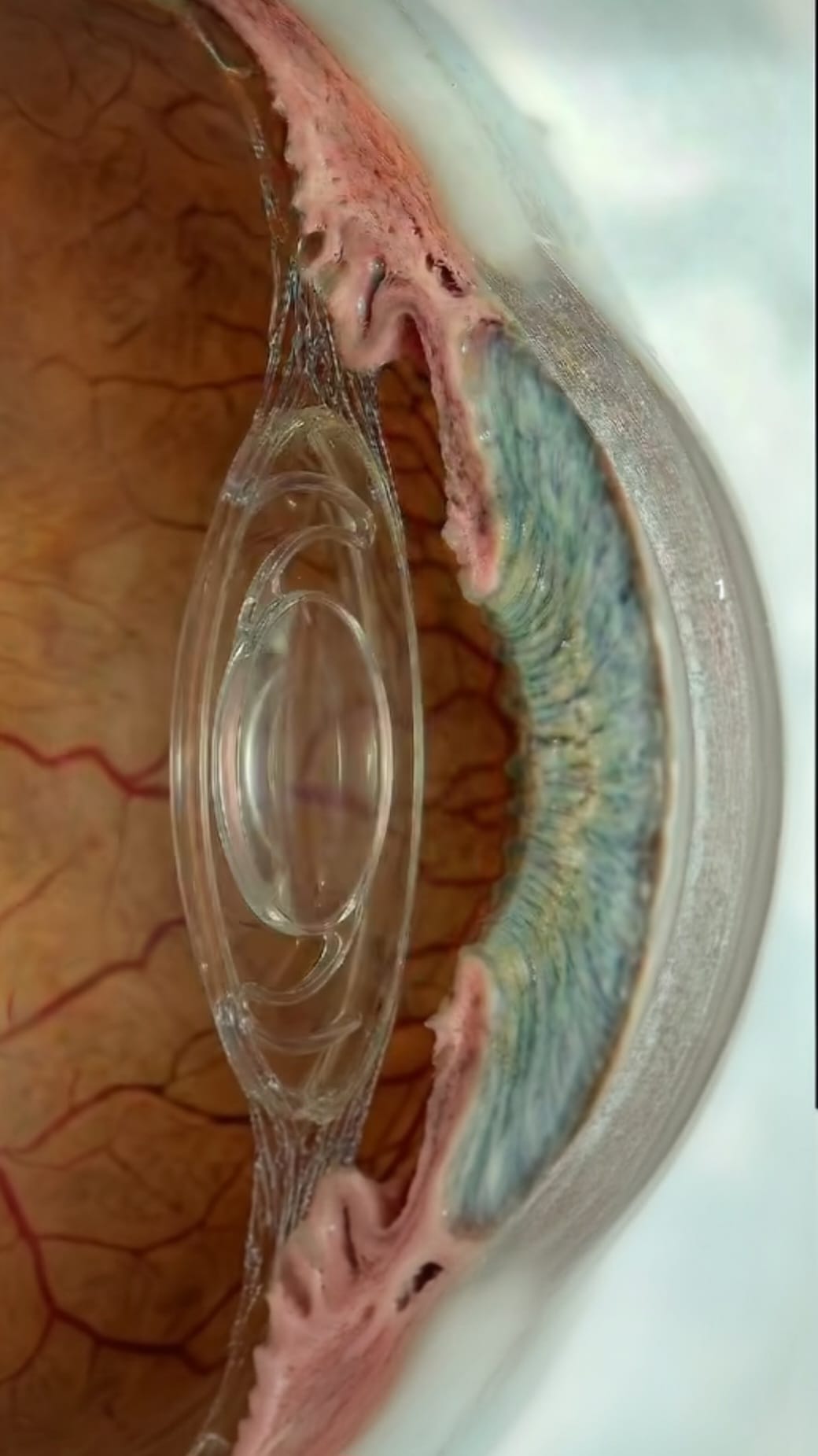 Implant intraoculaire en place après chirurgie de la cataracte — coupe sagittale de l'œil
