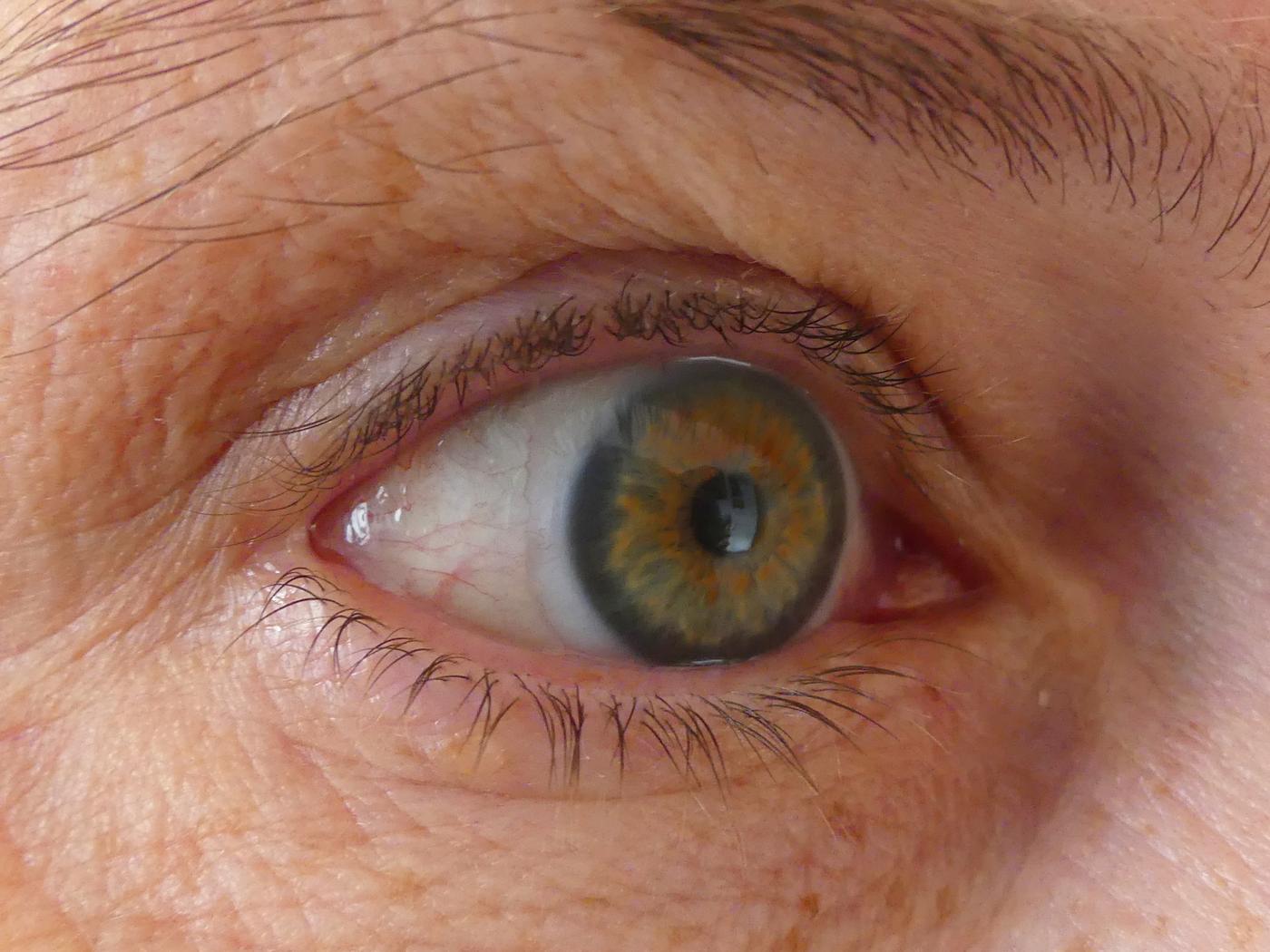 Lentille de contact souple sur l'œil