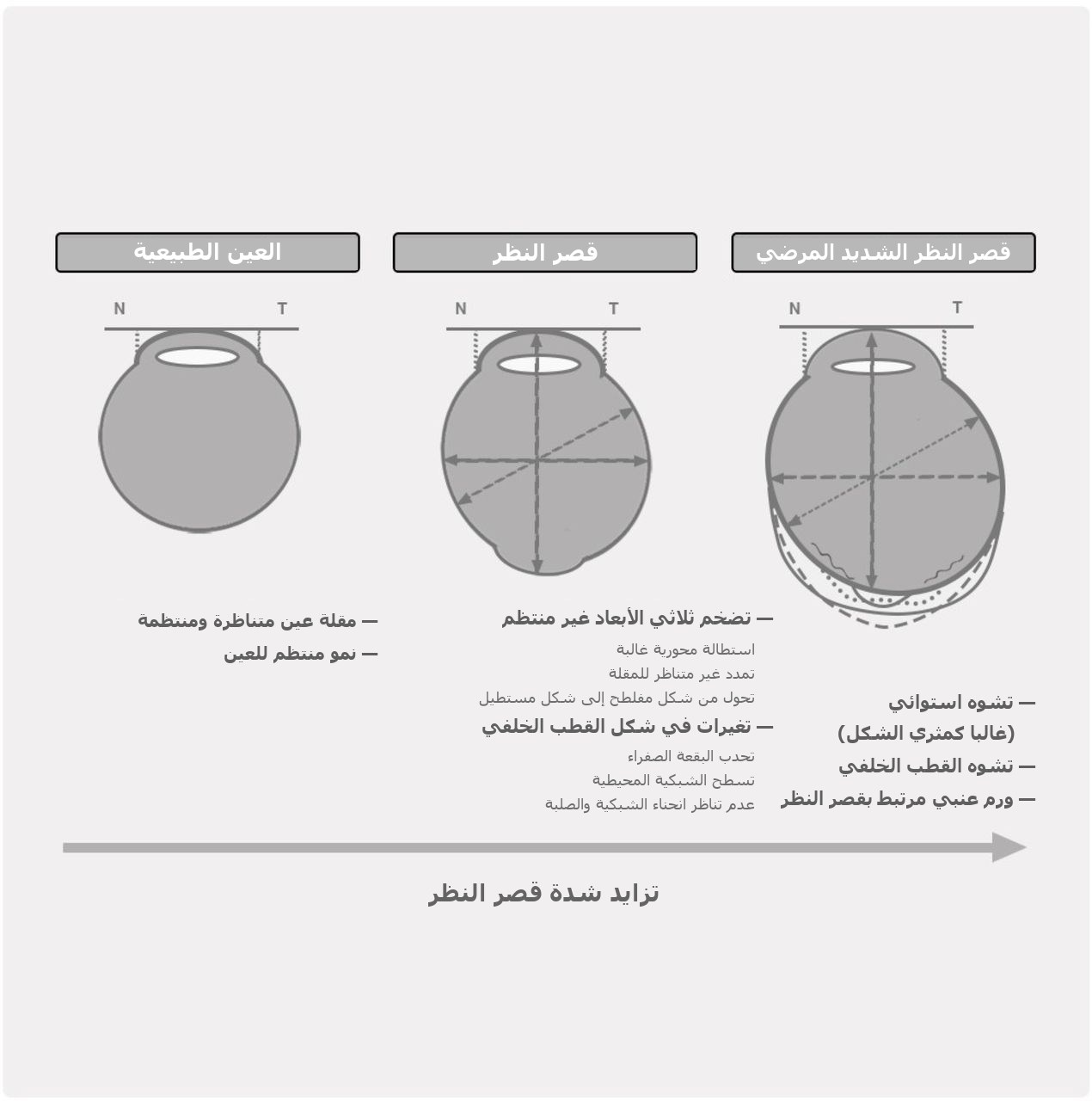 مخطط التشوه التدريجي لمقلة العين: العين الطبيعية، قصر النظر، ثم قصر النظر الشديد المرضي مع تشوه استوائي وخلفي (ورم عنبي)