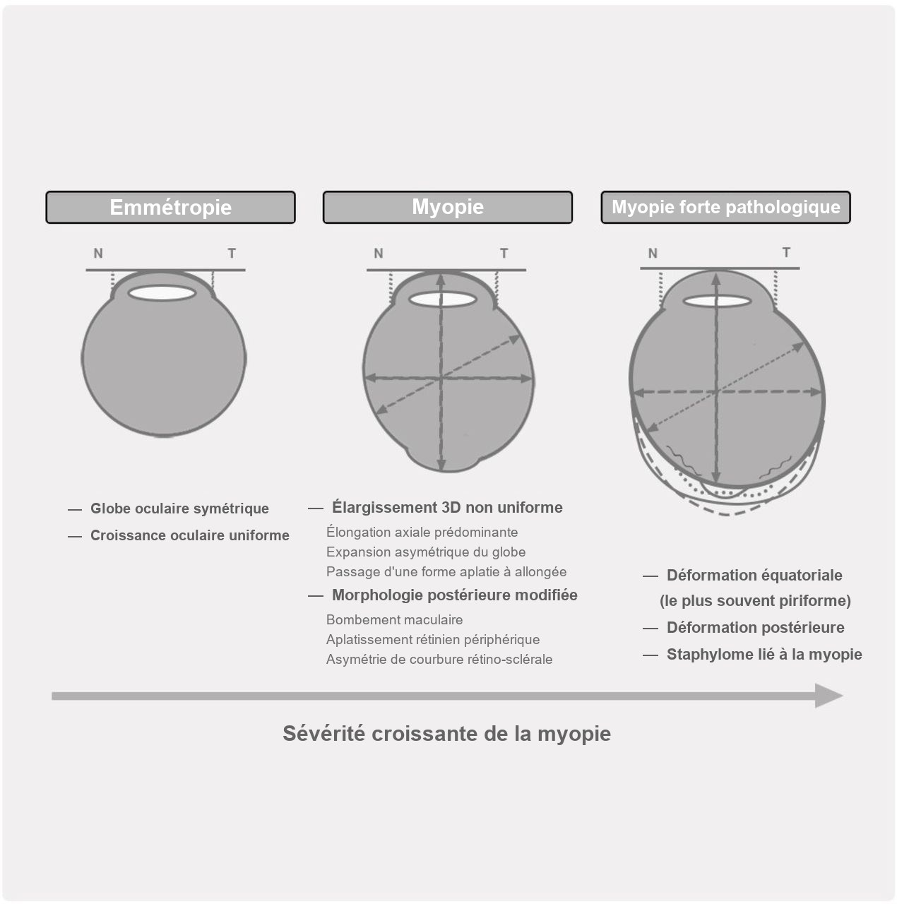 Schéma de la déformation progressive du globe oculaire : œil emmétrope symétrique, œil myope allongé, puis myopie forte pathologique avec déformations équatoriale et postérieure (staphylome)