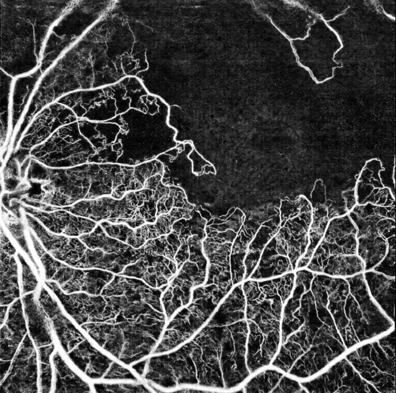 Image d'angio-OCT (OCT-A) montrant une r&eacute;tinopathie diab&eacute;tique avec de larges zones noires de non-perfusion capillaire (occlusion capillaire) et une fov&eacute;a centrale visible.