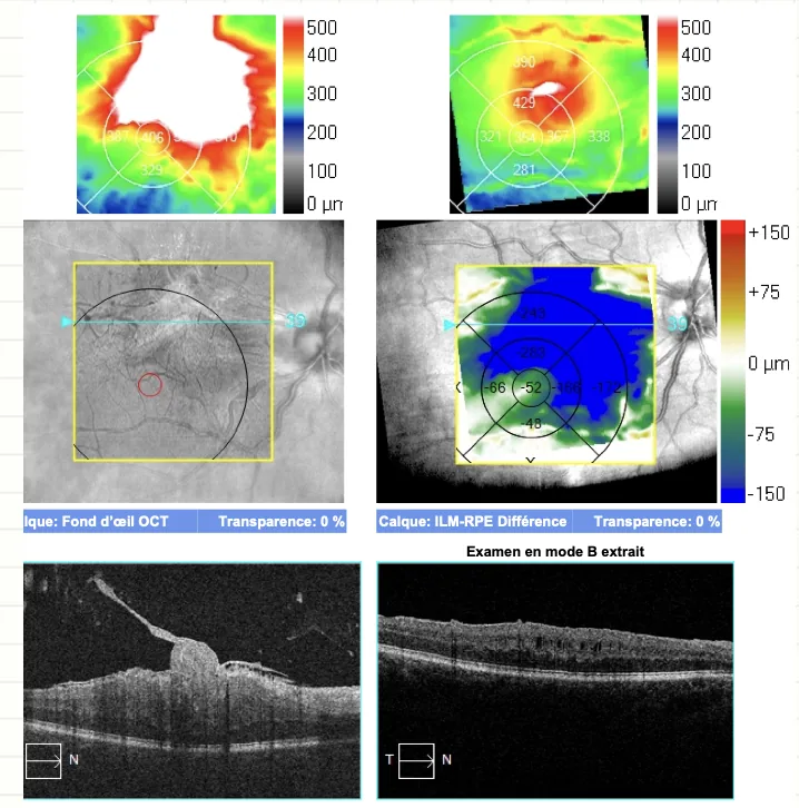 OCT maculaire montrant une membrane &eacute;pir&eacute;tinienne exer&ccedil;ant une traction sur la fov&eacute;a, avec cartographie d'&eacute;paisseur r&eacute;tinienne augment&eacute;e et coupe B mettant en &eacute;vidence le soul&egrave;vement fov&eacute;olaire