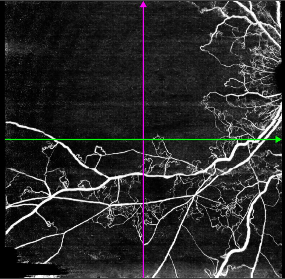 OCT-angiographie zoom sur la zone avasculaire