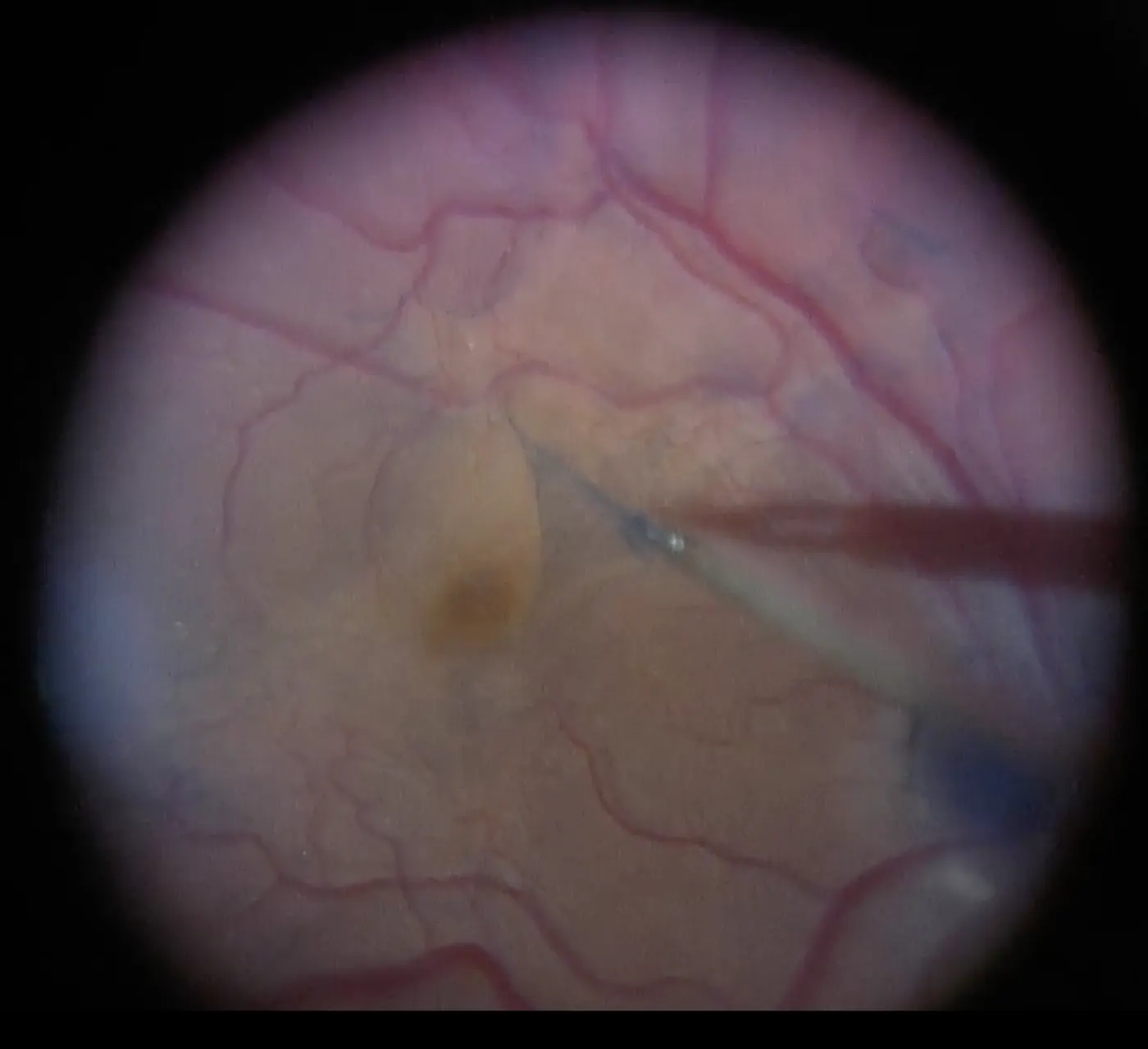 Vue per-op&eacute;ratoire au microscope : une micro-pince retire d&eacute;licatement la membrane &eacute;pir&eacute;tinienne &agrave; la surface de la macula pendant une vitrectomie