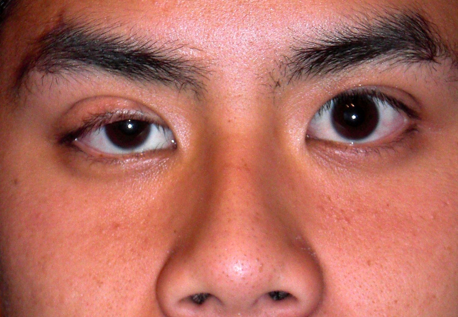 Ptosis congénital