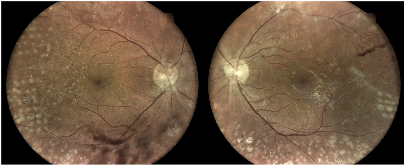 R&eacute;tinographies des deux yeux d'un patient atteint de r&eacute;tinopathie diab&eacute;tique prolif&eacute;rante apr&egrave;s photocoagulation panr&eacute;tinienne&nbsp;: les impacts laser cicatriciels (taches blanc&acirc;tres dispers&eacute;es) couvrent la r&eacute;tine p&eacute;riph&eacute;rique tandis que la macula est pr&eacute;serv&eacute;e.