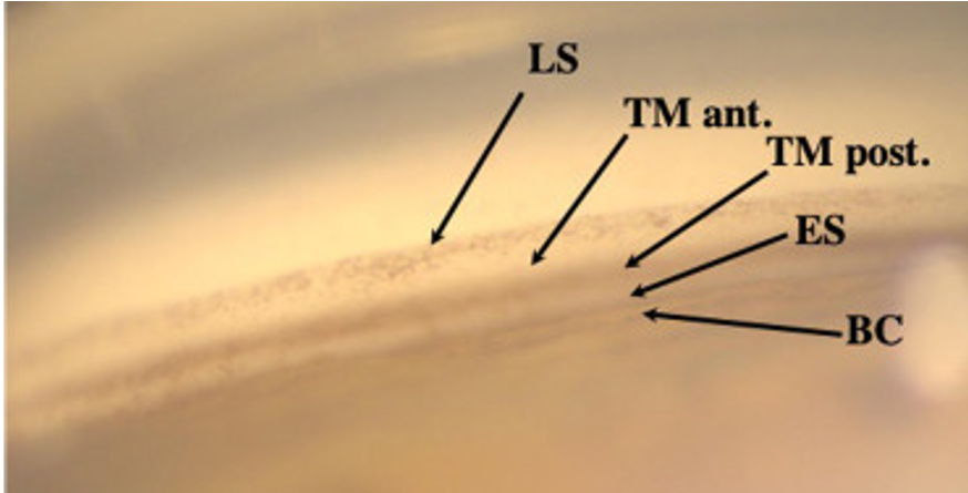 Vue gonioscopique de l'angle irido-cornéen lors d'un traitement SLT montrant le trabéculum