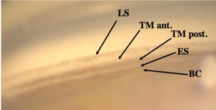 Vue gonioscopique de l'angle irido-corn&eacute;en lors d'un traitement SLT montrant le trab&eacute;culum vis&eacute; par le laser