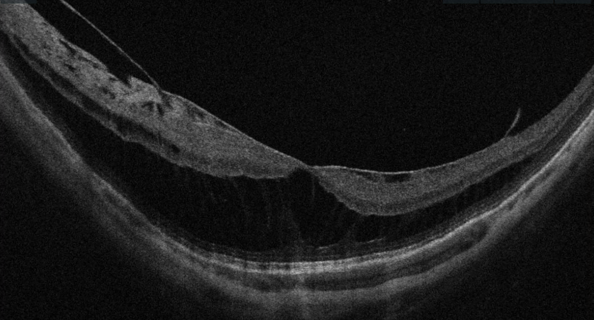 OCT maculaire montrant un fovéoschisis du myope fort — clivage des couches rétiniennes internes et externes au niveau fovéolaire